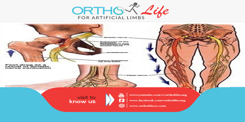 , أعراض مرض عرق النسا, ORTHO LIFE