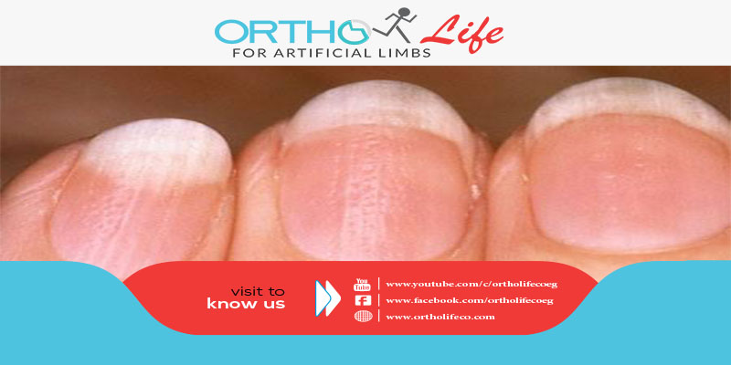 , اعراض نقص الحديد, ORTHO LIFE
