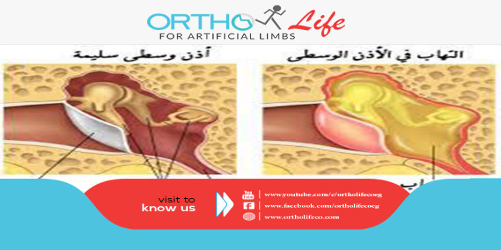 التهاب الأذن الوسطى