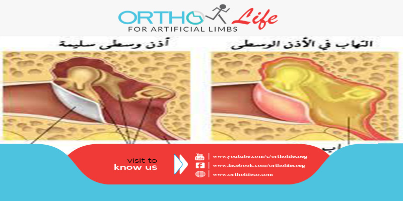 التهاب الأذن الخارجية Ortho Life
